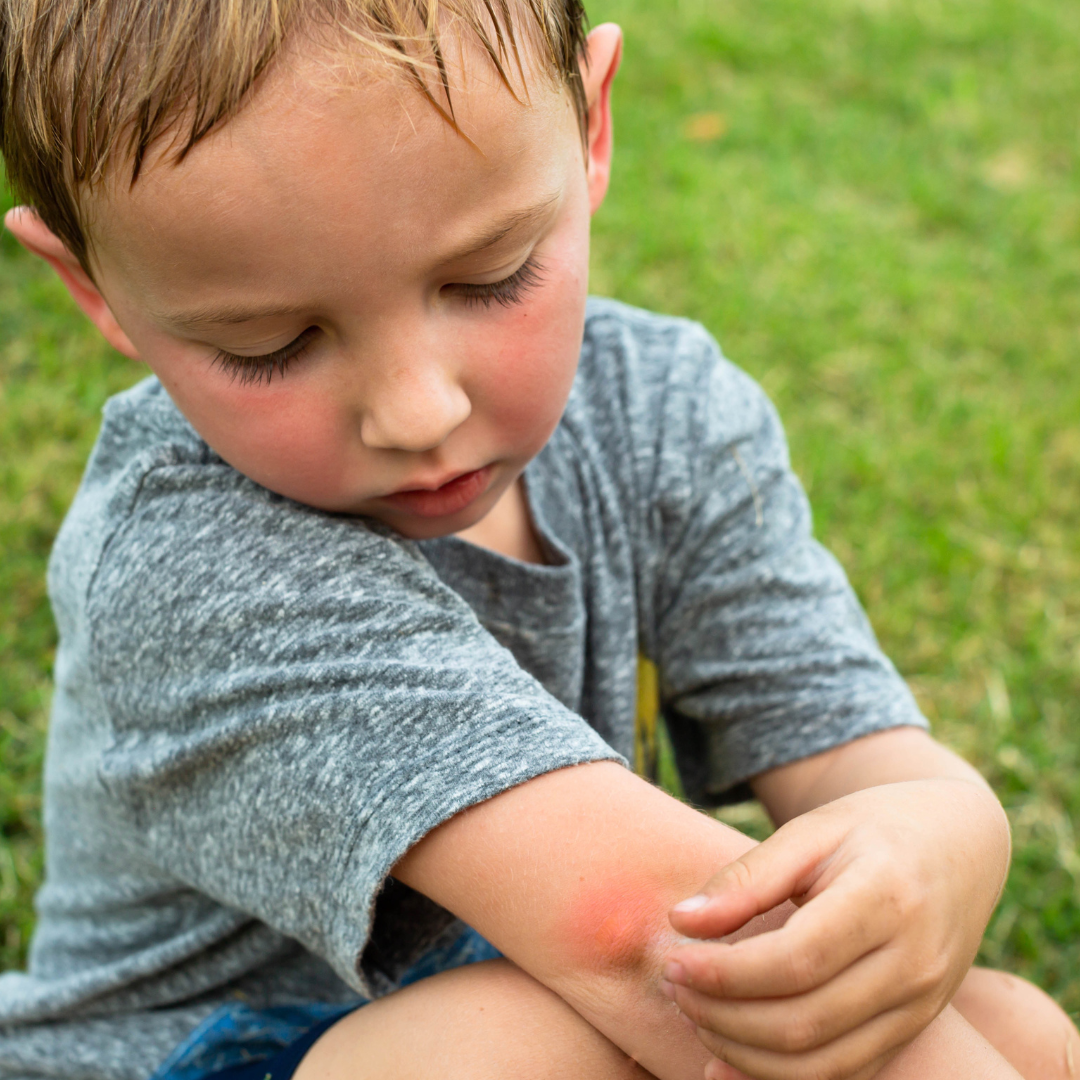 boy child looking at bite on his arm