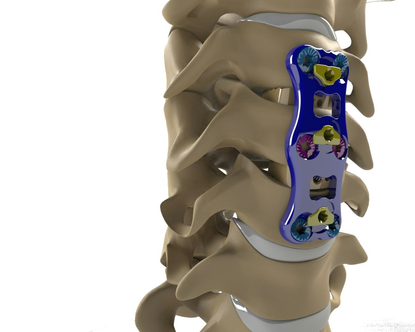 May contain: Cervical Plate