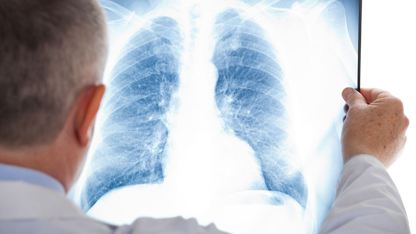 A medical professional examines an X-ray of human lungs, likely assessing for health issues or abnormalities.