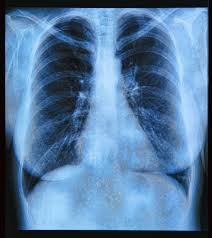 May contain: x-ray, ct scan, and medical imaging x-ray film