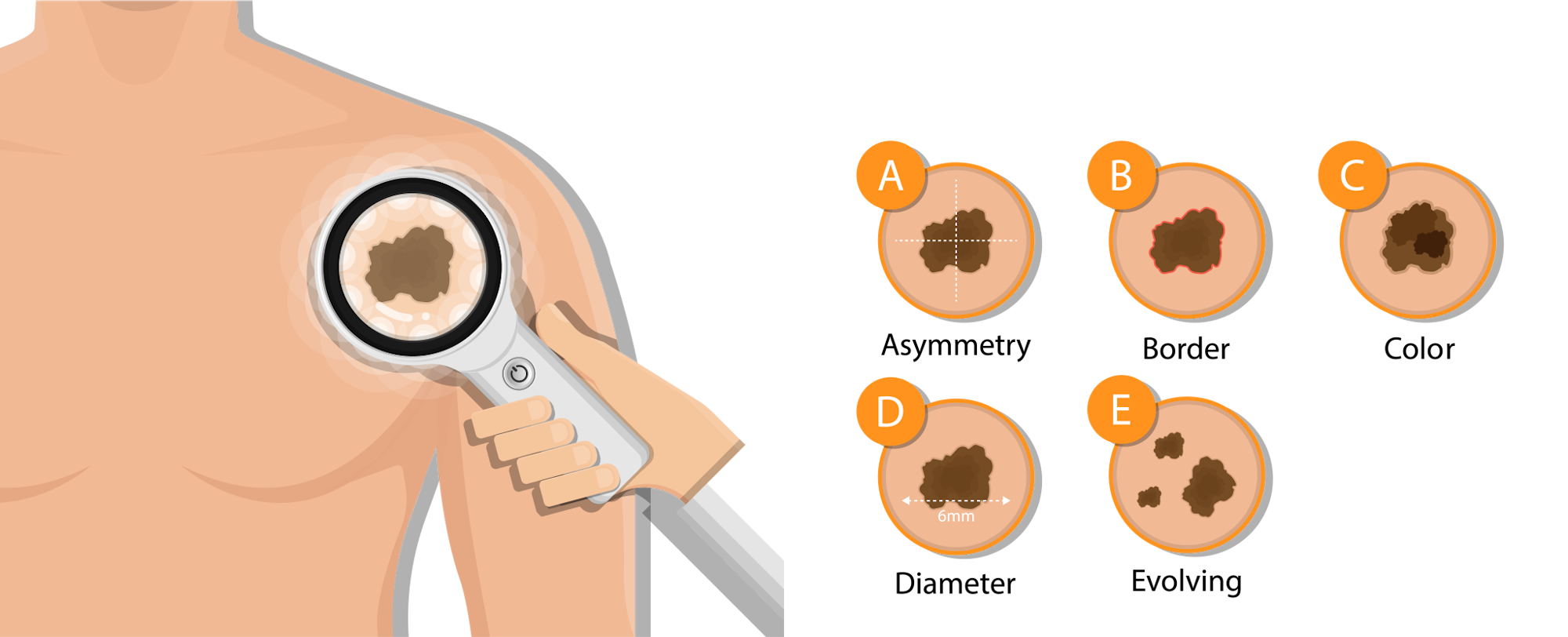 Educational illustration explaining the "ABCDE" warning signs of skin cancer, focusing on moles' characteristics.