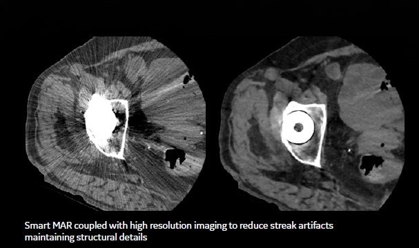 Smart MAR coupled with high resolution imaging to reduce streak artifacts maintaining structural details for CT.