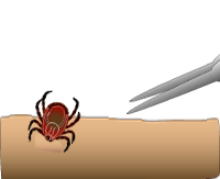 Tick removal